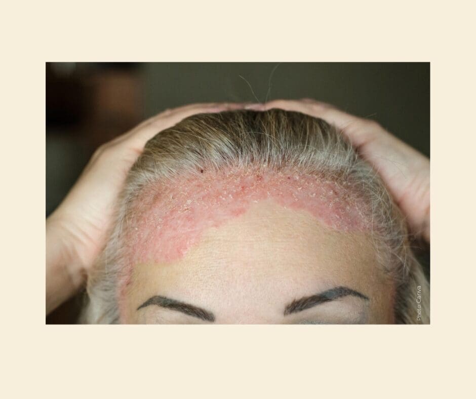 Close-up photo of an eczema sufferer's forehead