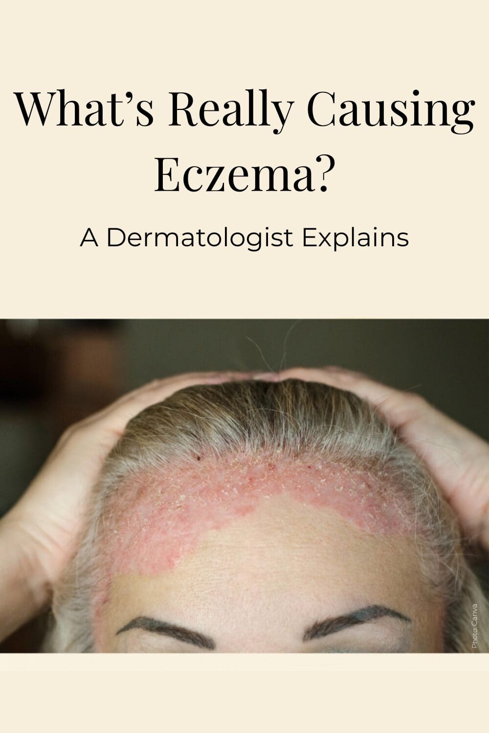 The forehead of a woman suffering from eczema